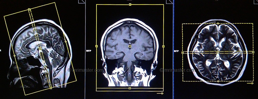 MRI-BRAIN SEIZURE PROTOCOL LabTest