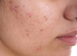 Complete Homeopathic Solution for Acne in 30 Days