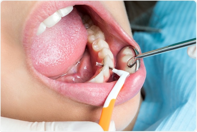 dental implant package