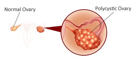 what is pcod/pcos