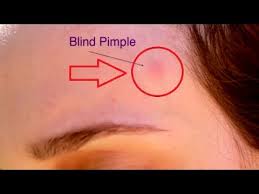 Blind Pimple