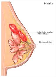 Breast Infection Mastitis