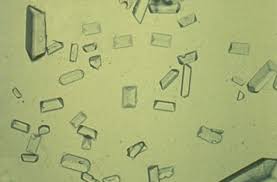 Crystals in Urine LabTest