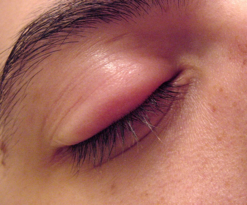 Eye Stye Causes And Treatments Of Styes On Eyelids