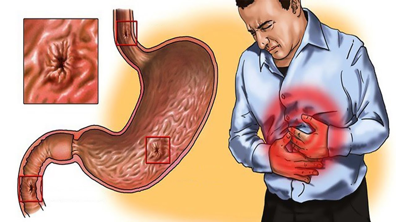 What Causes Gastritis? Symptoms, Foods to Avoid & Home Remedies