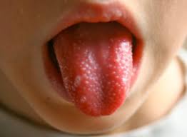 Blisters on Tongue