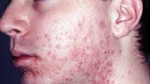 Skin Fungal Infection Treatment, Cause in Hindi