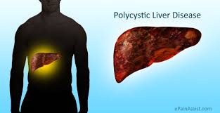 Polycystic Liver Disease