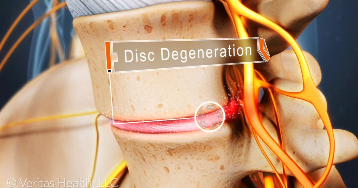 Degenerative Disc