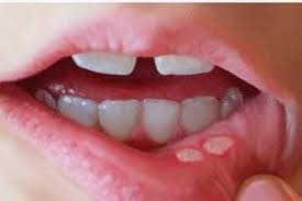 Mouth ulcer