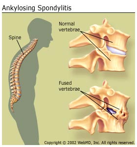 Ankylosing spondylitis