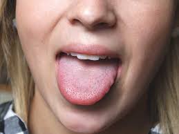 Sore Tongue