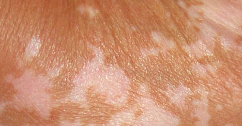 Discolored skin patches