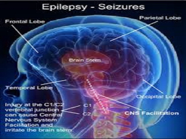 मिरगी रोग (EPILEPSY) की योग एवं प्राकृतिक चिकित्सा