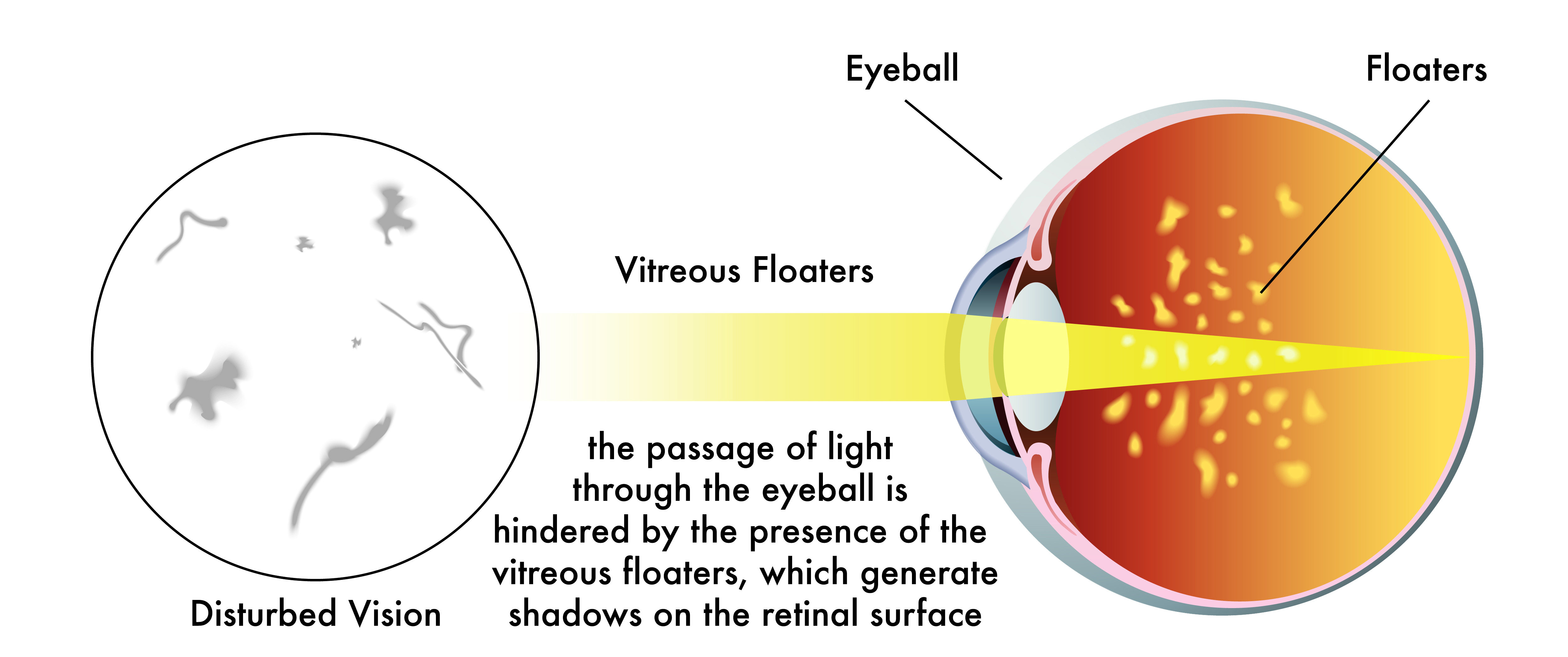 Eye floaters