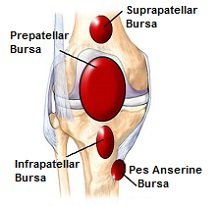 Knee bursitis