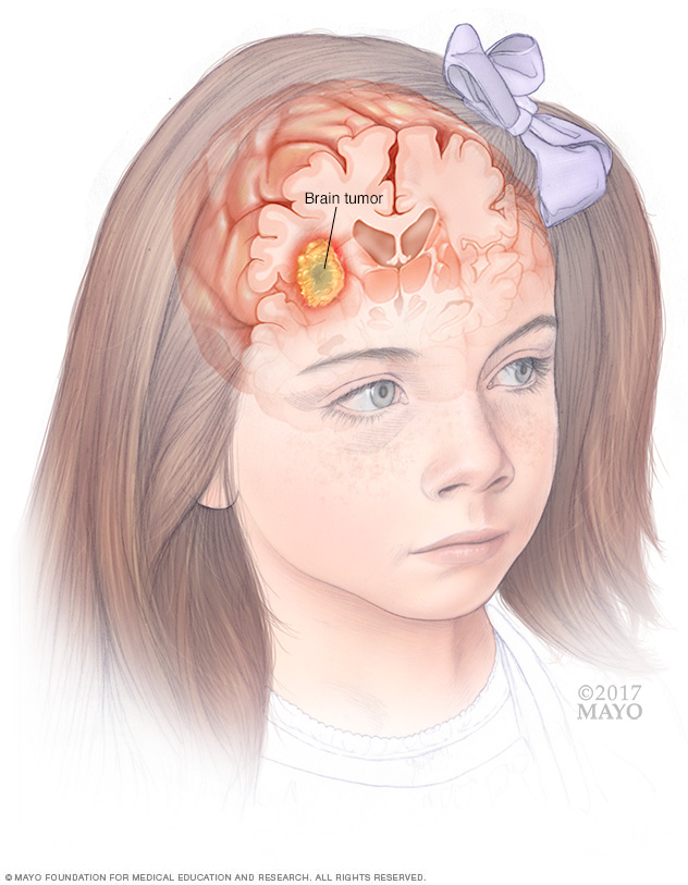 Pediatric brain tumors