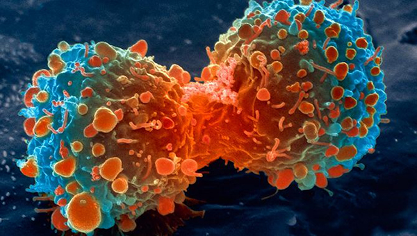 Cancer: Overview, Symptoms, Types Diagnostic and Treatments
