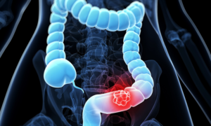 Colorectal Cancer- Causes, Staging, Symptoms and Treatment