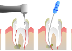 What-is-a-Root-Canal-Overview-Treatment