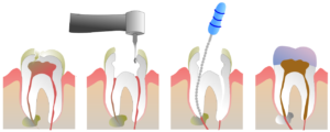 What-is-a-Root-Canal-Overview-Treatment