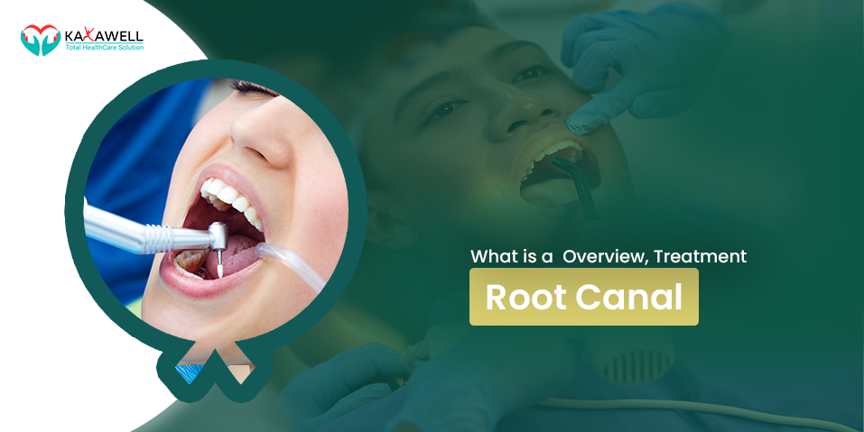 What is a Root Canal, Overview, Treatment