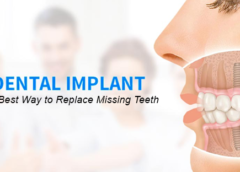 Dental Implants