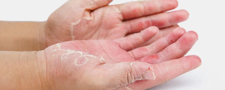 Skin disease Causes Symptoms and Natural Treatment