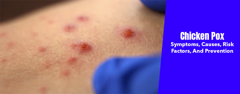 Chicken Pox- Symptoms, Causes, Risk Factors, And Prevention