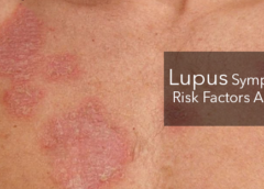 Lupus- Symptoms, Causes, Risk Factors and Prevention
