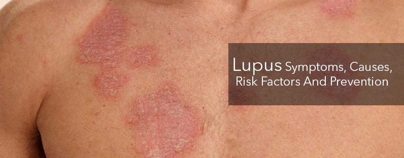 Lupus- Symptoms, Causes, Risk Factors And Prevention