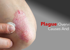 Plague- Overview, Symptoms, Causes and Prevention