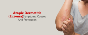 Atopic Dermatitis (Eczema) – Symptoms, Causes And Prevention