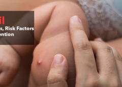 Boil- Symptoms, Causes, Risk Factors and Prevention