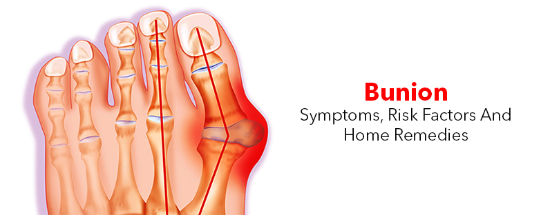 Bunion- Symptoms, Risk Factors And Home Remedies