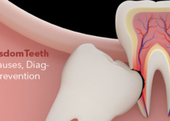 Impacted Wisdom Teeth- Symptoms, Causes, Diagnosis And Prevention