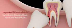 Impacted Wisdom Teeth- Symptoms, Causes, Diagnosis And Prevention