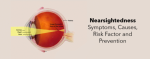 Nearsightedness- Symptoms, Causes, Risk Factor and Prevention
