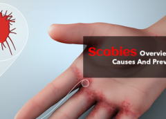 Scabies- overview, symptoms, causes and prevention
