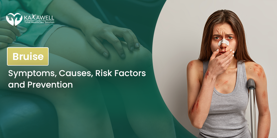 Bruise- Symptoms, Causes, Risk Factors and Prevention