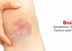 Bruise- Symptoms, Causes, Risk Factors and Prevention