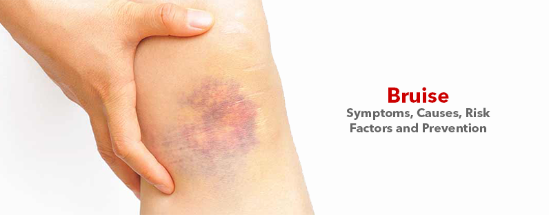 Bruise- Symptoms, Causes, Risk Factors and Prevention