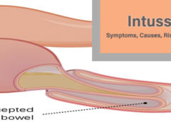 Intussusception- Symptoms, Causes, Risk Factors and Complications