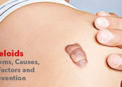 Keloids- Symptoms, Causes, Risk Factors and Prevention