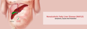 Nonalcoholic-Fatty-Liver-Disease-(NAFLD)-–-Symptoms,-Causes-And-Prevention