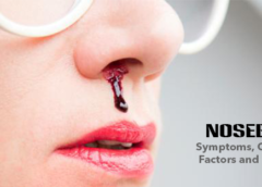 Nosebleed- Symptoms, Causes, Risk Factors and Prevention