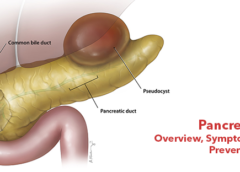 Pancreatitis- Overview, Symptoms, Causes and Prevention