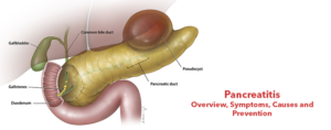Pancreatitis- Overview, Symptoms, Causes and Prevention