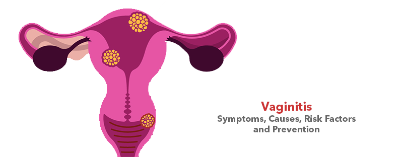 Vaginitis- Symptoms, Causes, Risk Factors and Prevention