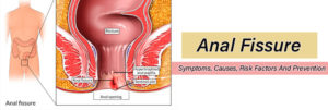 Anal-Fissure-–-Symptoms,-Causes,-Risk-Factors-And-Prevention